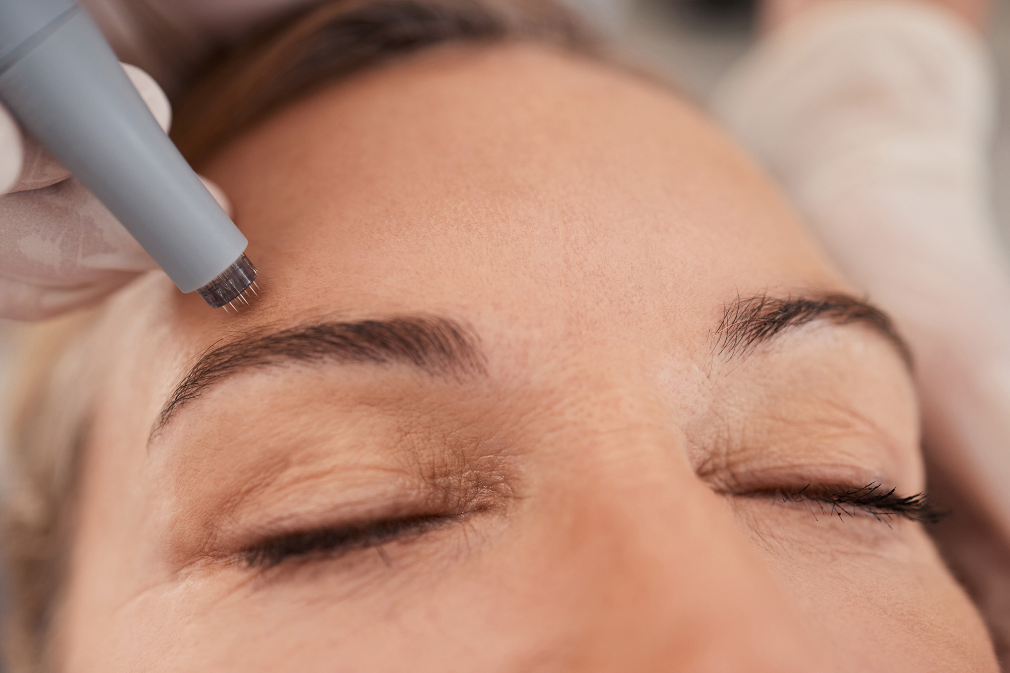 micro needling