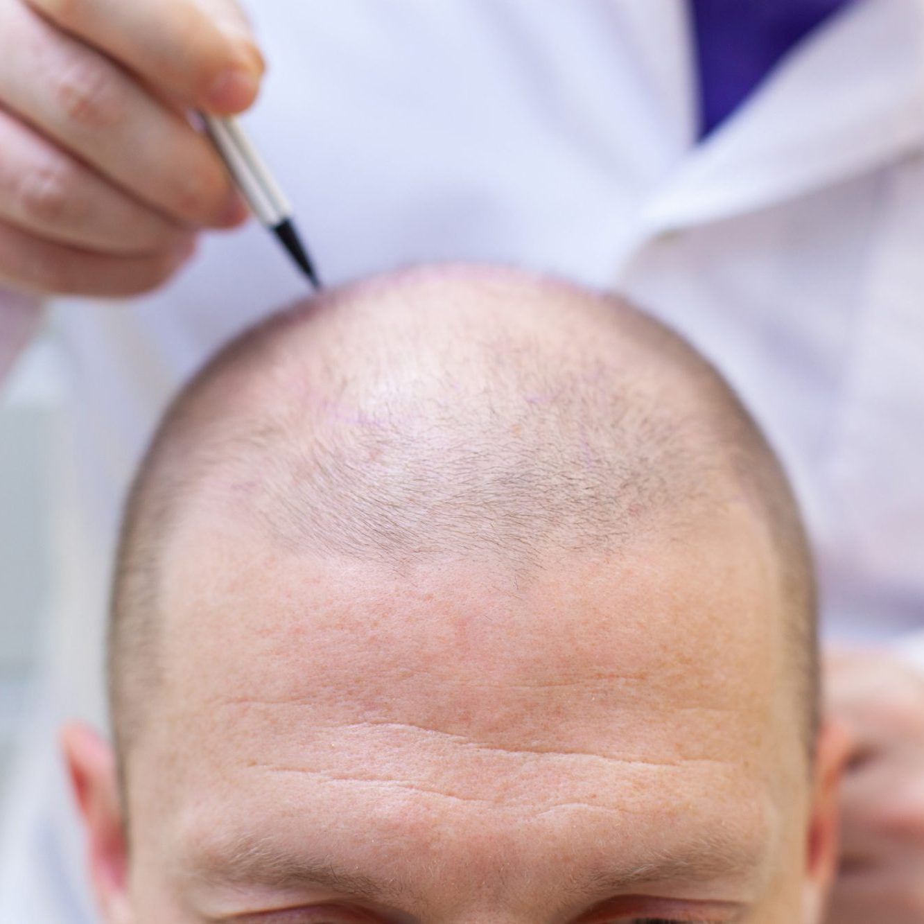 dreamstime_m_148822045 cfdd Hair Restoration
