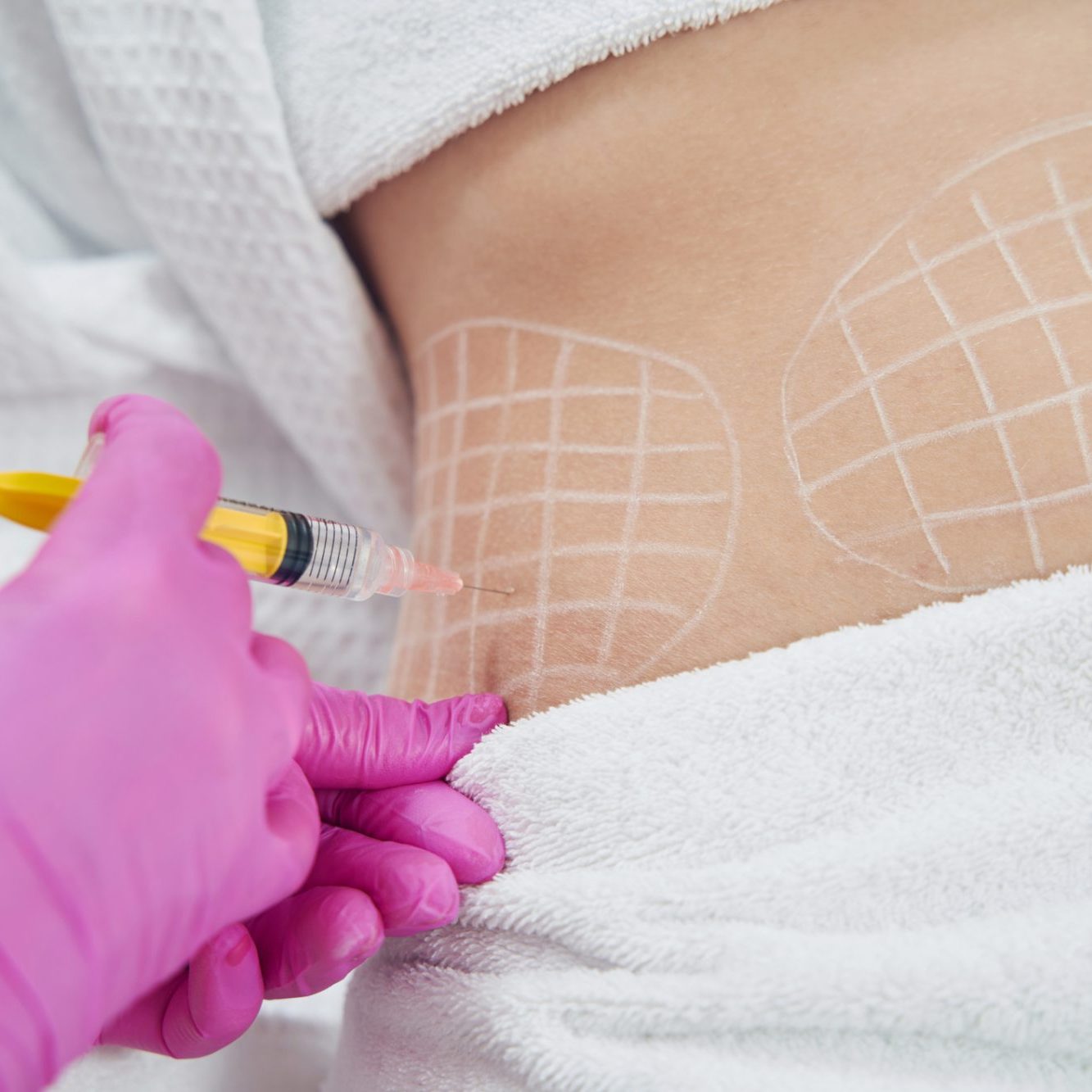Fat Dissolving Treatments