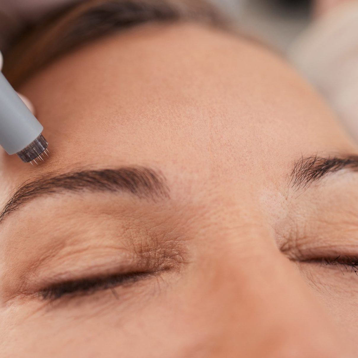 micro needling