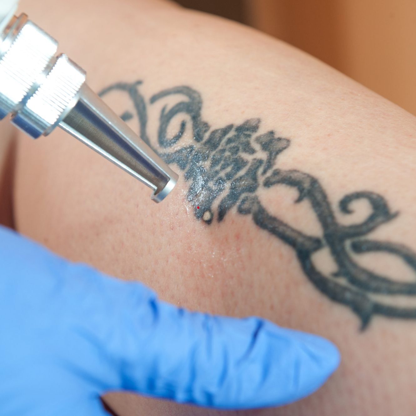 dreamstime_m_78640360 Tattoo Removal