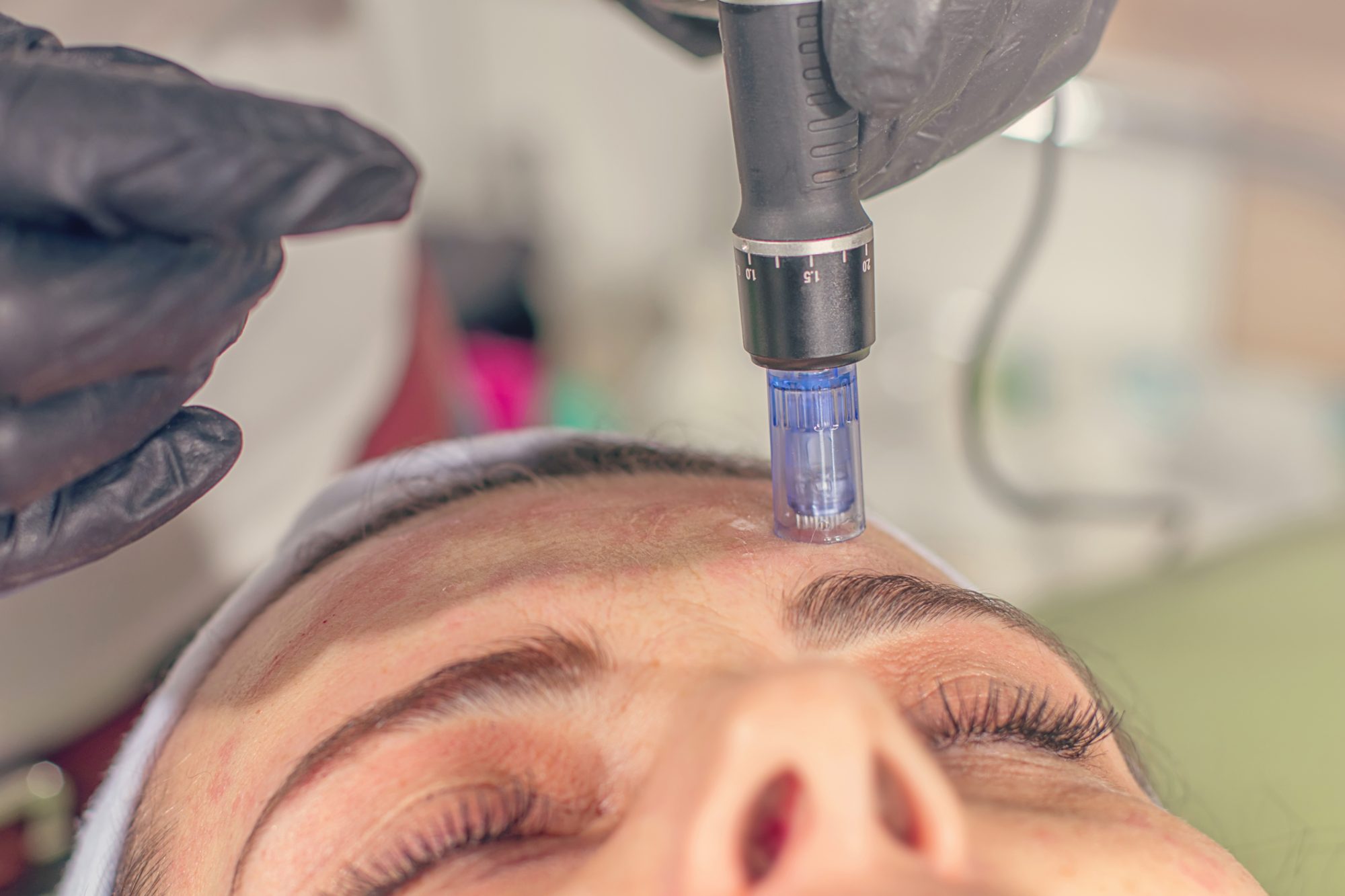 micro needling