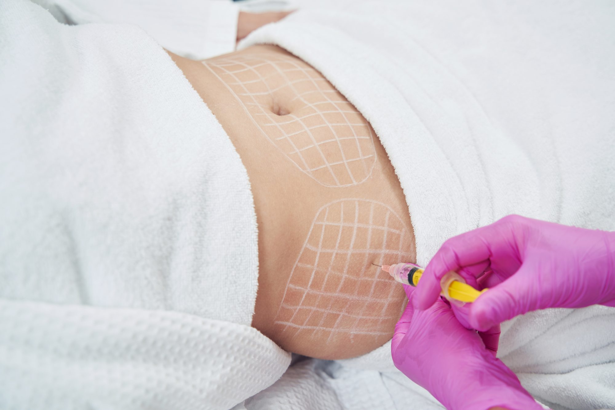 Fat Dissolving Treatments